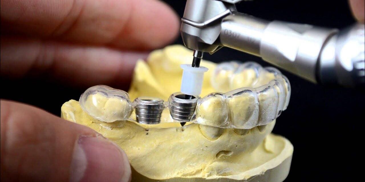 كيفية الاستعداد لعملية زراعة الأسنان نصائح مهمة قبل وبعد العملية